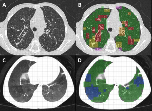 Lung Image