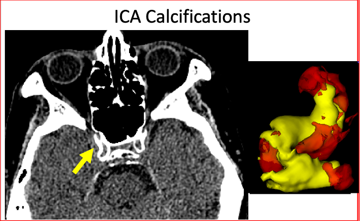 Contribution as Population Imaging Flagship Node to imaging of vascular calcifications in the brain